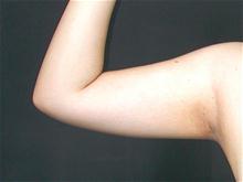 Liposuction Before Photo by Robert Kure, MD, PhD; Tokyo,  - Case 27881