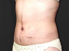 Tummy Tuck After Photo by Robert Kure, MD, PhD; Tokyo,  - Case 27884