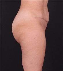 Tummy Tuck After Photo by Leyla Arvas, MD PhD; Istanbul, C - Case 49456