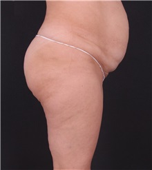 Tummy Tuck Before Photo by Leyla Arvas, MD PhD; Istanbul, C - Case 49456