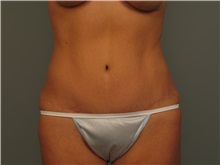 Tummy Tuck After Photo by Bahair Ghazi, MD; Atlanta, GA - Case 28095