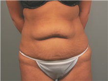 Tummy Tuck Before Photo by Bahair Ghazi, MD; Atlanta, GA - Case 28095