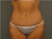 Body Contouring After Photo by Bahair Ghazi, MD; Atlanta, GA - Case 28096