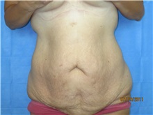 Body Contouring Before Photo by Bahair Ghazi, MD; Atlanta, GA - Case 28096