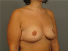 Breast Lift After Photo by Bahair Ghazi, MD; Atlanta, GA - Case 28097