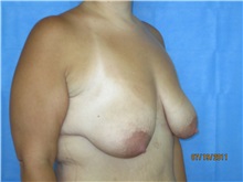 Breast Lift Before Photo by Bahair Ghazi, MD; Atlanta, GA - Case 28097