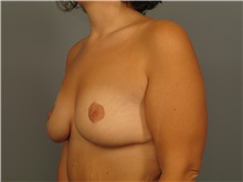 Breast Lift After Photo by Bahair Ghazi, MD; Atlanta, GA - Case 28097