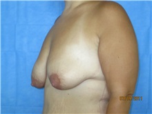 Breast Lift Before Photo by Bahair Ghazi, MD; Atlanta, GA - Case 28097