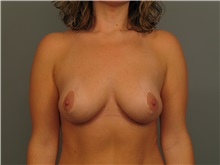 Breast Lift After Photo by Bahair Ghazi, MD; Atlanta, GA - Case 28098