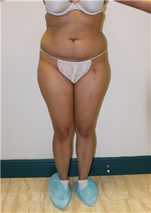 Liposuction Before Photo by Wendell Perry, MD; Alexandria, VA - Case 27730