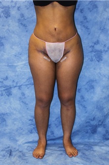 Liposuction After Photo by Wendell Perry, MD; Doral, FL - Case 27732