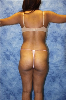 Liposuction Before Photo by Wendell Perry, MD; Doral, FL - Case 27732