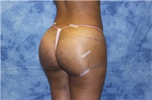 Liposuction After Photo by Wendell Perry, MD; Doral, FL - Case 27732