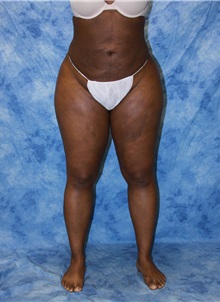 Liposuction After Photo by Wendell Perry, MD; Alexandria, VA - Case 27733