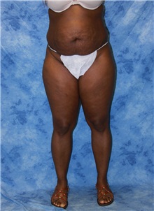 Liposuction Before Photo by Wendell Perry, MD; Alexandria, VA - Case 27733