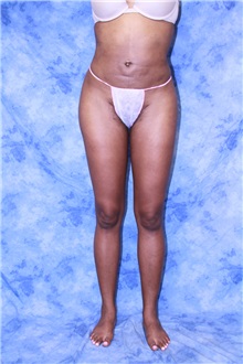 Liposuction After Photo by Wendell Perry, MD; Alexandria, VA - Case 27734