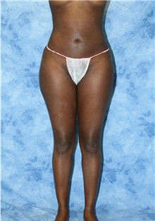 Liposuction After Photo by Wendell Perry, MD; Doral, FL - Case 27737