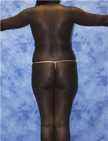 Liposuction Before Photo by Wendell Perry, MD; Doral, FL - Case 27737