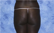 Liposuction Before Photo by Wendell Perry, MD; Doral, FL - Case 27737