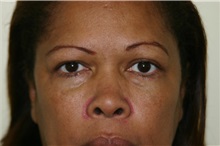 Eyelid Surgery After Photo by Wendell Perry, MD; Alexandria, VA - Case 27739