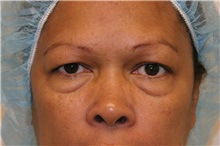 Eyelid Surgery Before Photo by Wendell Perry, MD; Alexandria, VA - Case 27739