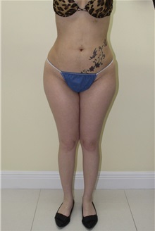 Liposuction After Photo by Wendell Perry, MD; Alexandria, VA - Case 27741