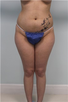 Liposuction Before Photo by Wendell Perry, MD; Alexandria, VA - Case 27741