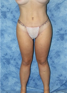 Liposuction After Photo by Wendell Perry, MD; Alexandria, VA - Case 27745