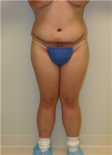 Liposuction Before Photo by Wendell Perry, MD; Alexandria, VA - Case 27745