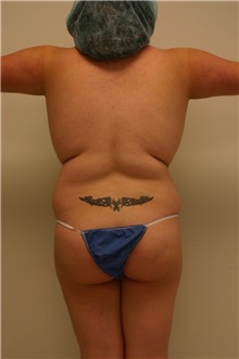 Liposuction Before Photo by Wendell Perry, MD; Alexandria, VA - Case 27745