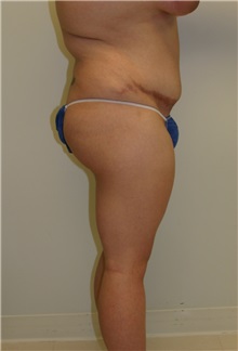 Liposuction Before Photo by Wendell Perry, MD; Alexandria, VA - Case 27745