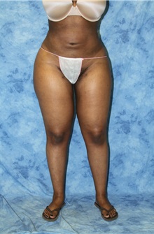 Liposuction After Photo by Wendell Perry, MD; Alexandria, VA - Case 27747