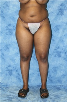 Liposuction Before Photo by Wendell Perry, MD; Alexandria, VA - Case 27747