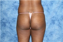 Liposuction Before Photo by Wendell Perry, MD; Doral, FL - Case 27749