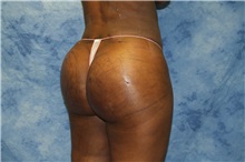 Liposuction After Photo by Wendell Perry, MD; Doral, FL - Case 27749