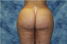 Liposuction After Photo by Wendell Perry, MD; Doral, FL - Case 27750