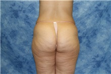 Liposuction Before Photo by Wendell Perry, MD; Doral, FL - Case 27750