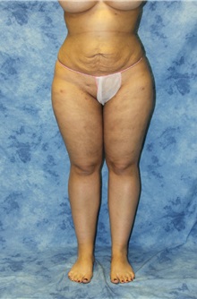 Liposuction After Photo by Wendell Perry, MD; Alexandria, VA - Case 27760