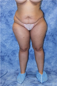 Liposuction Before Photo by Wendell Perry, MD; Alexandria, VA - Case 27760