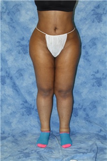 Liposuction After Photo by Wendell Perry, MD; Alexandria, VA - Case 27764