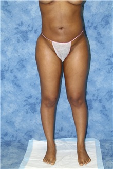 Liposuction After Photo by Wendell Perry, MD; Alexandria, VA - Case 27765