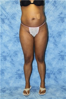 Liposuction Before Photo by Wendell Perry, MD; Doral, FL - Case 27766