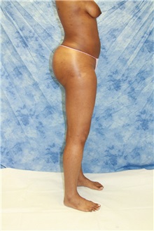 Liposuction After Photo by Wendell Perry, MD; Doral, FL - Case 27766