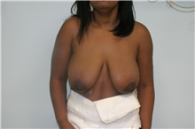 Breast Lift Before Photo by Wendell Perry, MD; Alexandria, VA - Case 27768