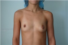 Breast Augmentation Before Photo by Wendell Perry, MD; Alexandria, VA - Case 27769