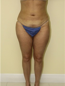 Liposuction After Photo by Wendell Perry, MD; Alexandria, VA - Case 27771