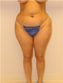 Liposuction Before Photo by Wendell Perry, MD; Alexandria, VA - Case 27771