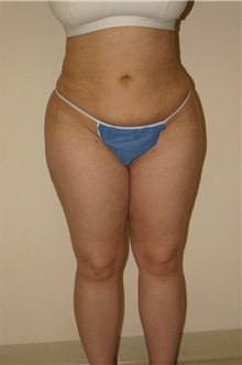 Liposuction After Photo by Wendell Perry, MD; Alexandria, VA - Case 27772