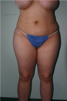 Liposuction Before Photo by Wendell Perry, MD; Alexandria, VA - Case 27772