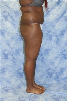 Liposuction Before Photo by Wendell Perry, MD; Doral, FL - Case 27774
